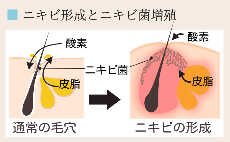 角質の肥厚とニキビ菌増殖