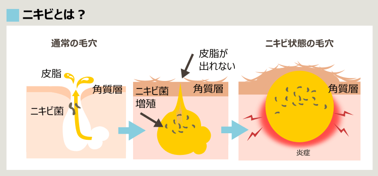 ニキビ形成プロセス