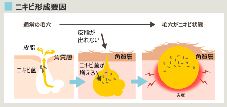 毛穴がニキビになる過程