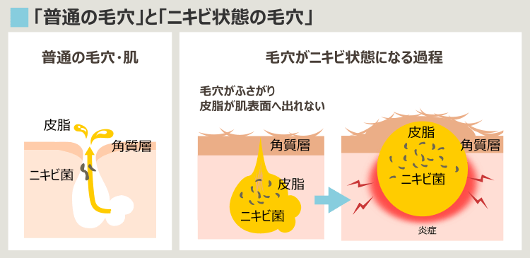 ニキビのイタチごっこ-ニキビの原因・プロセス