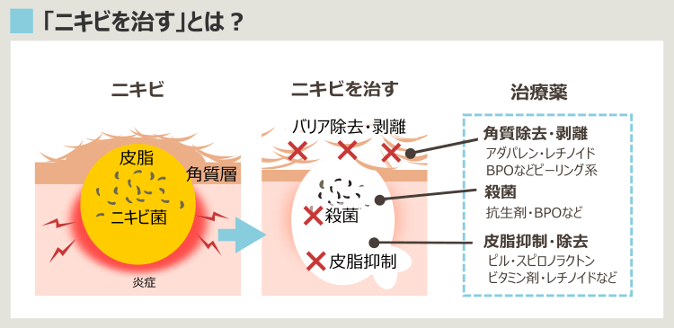 ニキビのイタチごっこ-ニキビ治療のニキビへの効果
