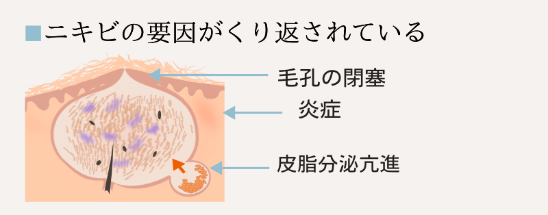 cause-of-chronic-acne1