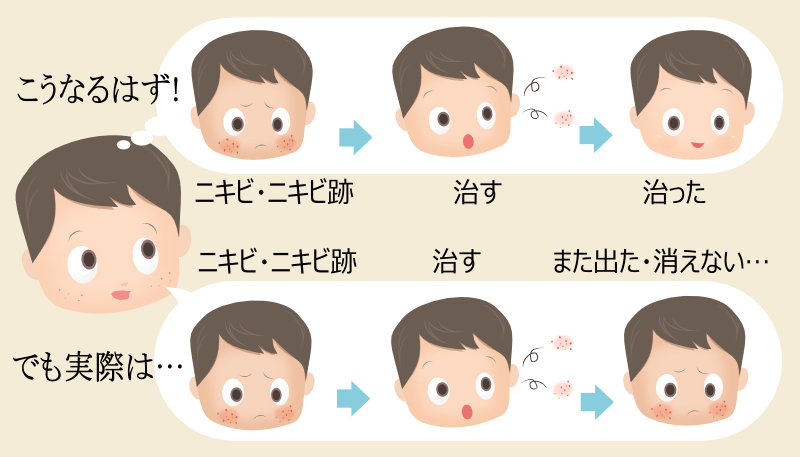 ニキビとニキビ跡を繰り返す