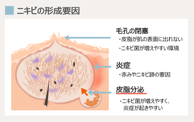 顎ニキビの原因はホルモンの病気か