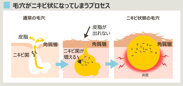 ニキビができる過程