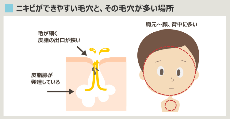 ニキビができやすい場所