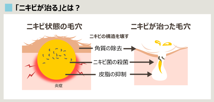 皮膚科などでのニキビ治療の目的や方法