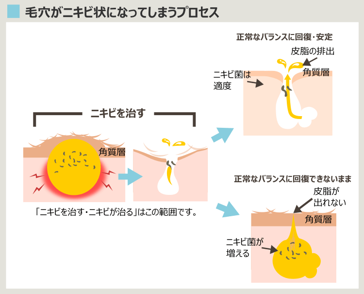 ニキビを治してもニキビができやすい人は、できやすいまま