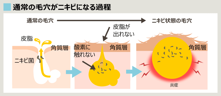 角質層の肥厚と、毛穴がニキビになる過程