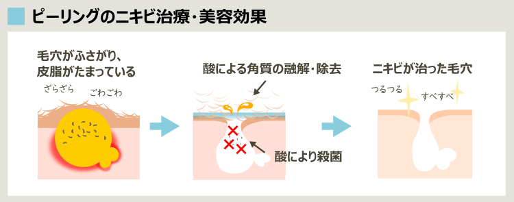 ピーリングの角質溶解によるニキビ治療効果と、美容効果