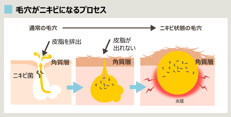 皮脂腺、角質層とニキビ形成のプロセス