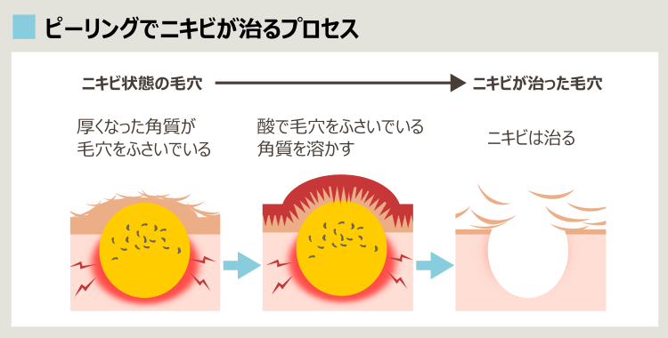 ピーリングの効果