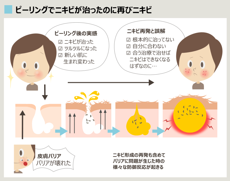 ピーリングでニキビ再発、肌トラブル悪化の要因