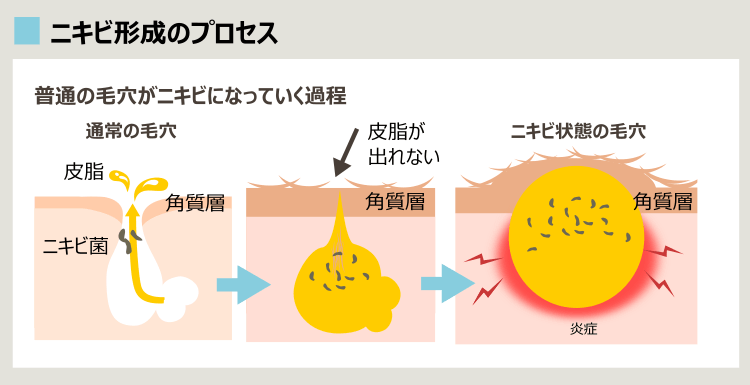 毛穴がニキビになるプロセス