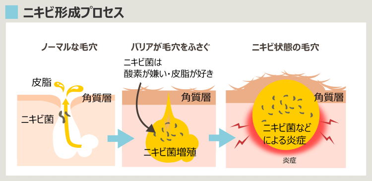 ニキビの形成プロセス