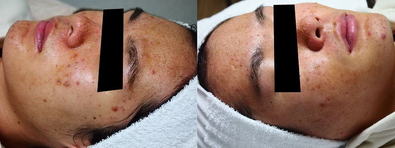 damage-of-skin-barrier-function-after-chemical-peeling