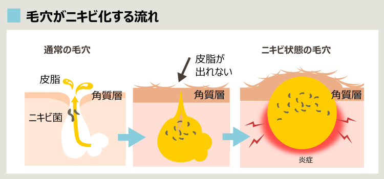 ニキビができるプロセス