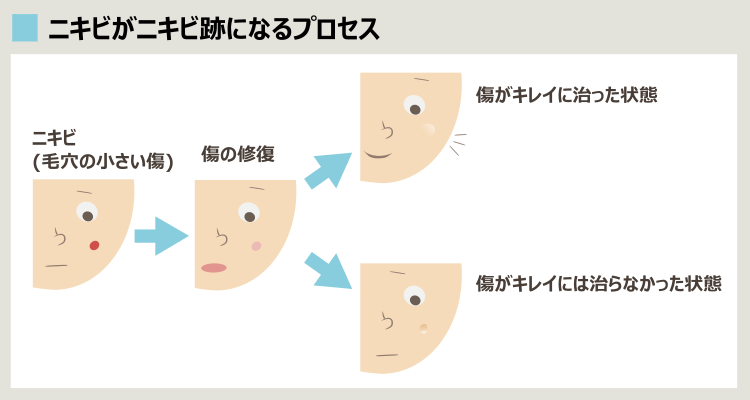 ニキビがキレイに治らなかった傷痕がニキビ跡