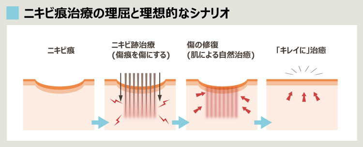 クレーターのニキビ跡とダーマペンの効果