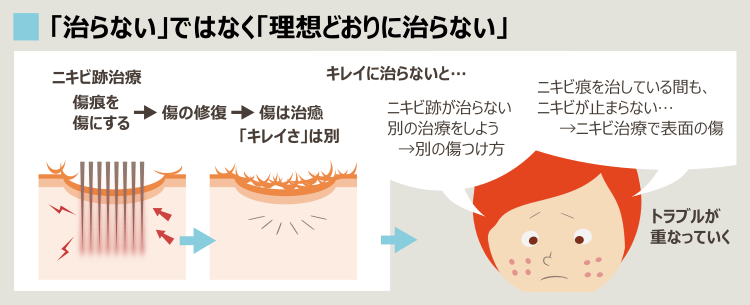 クレーターは治らないし、ニキビも出続ける状態