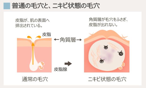 角質層が厚くなり、ニキビを形成する