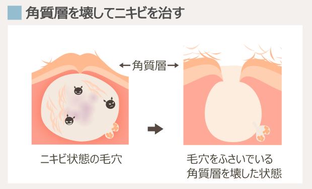 ディフェリンの作用機序・ニキビへの効果