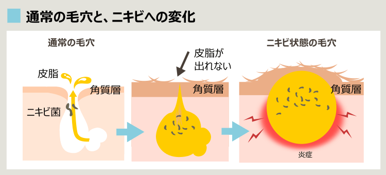 ニキビの原因