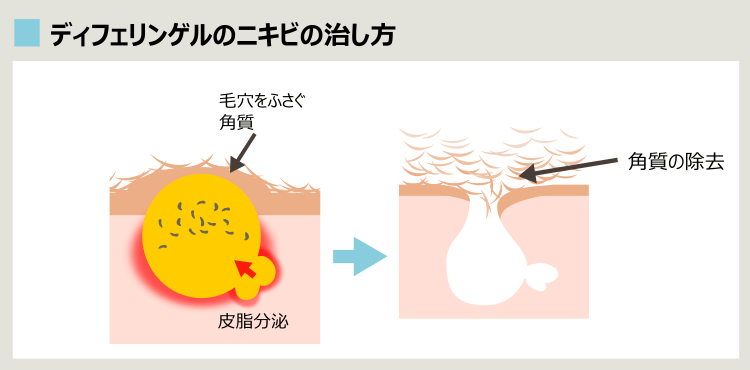 ディフェリンでニキビが治る場合