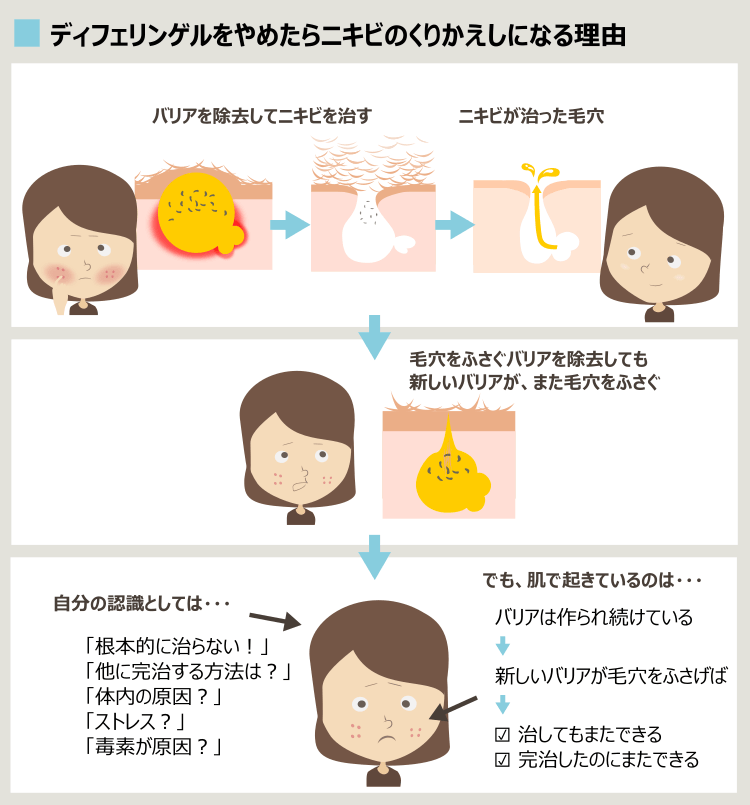 ディフェリンでニキビを治しても、止めると再発する理由