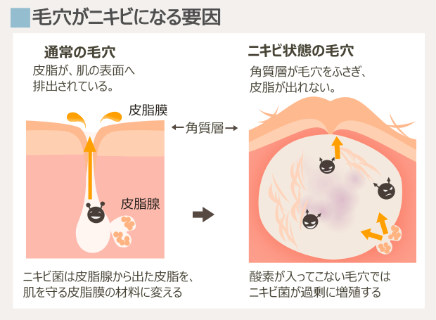 ニキビの形成要因