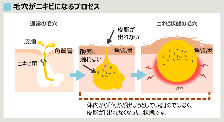 ニキビ形成プロセス