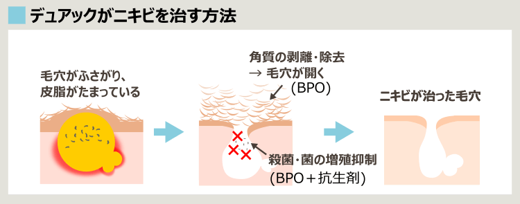 デュアックのニキビ治療効果