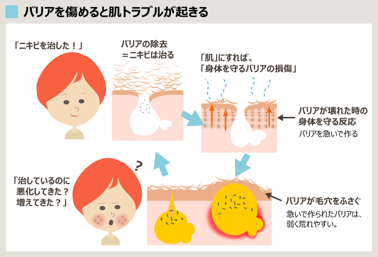 デュアックでニキビが悪化し増える理由