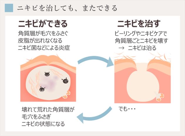 角質層を壊すニキビ治療