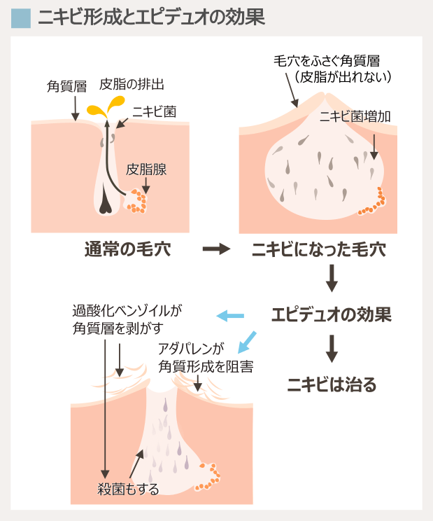 ニキビの原因とエピデュオゲルの効果