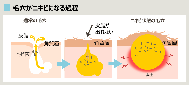 毛穴がニキビになる過程