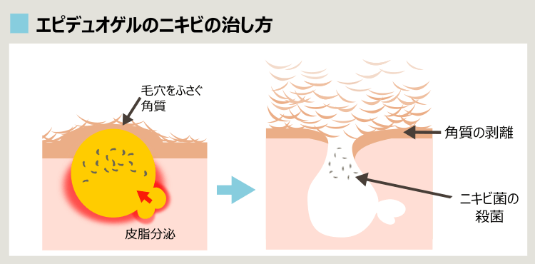 エピデュオゲルがニキビを治すプロセス