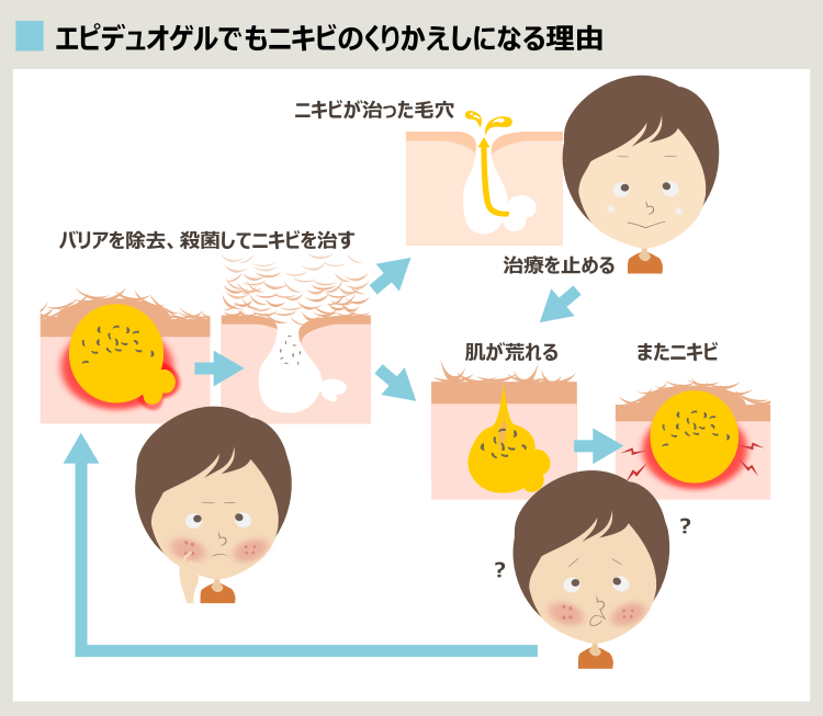 エピデュオゲルをやめるとニキビが再発する理由