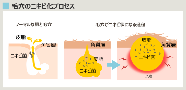 グルテンフリーに関係なくできるニキビ