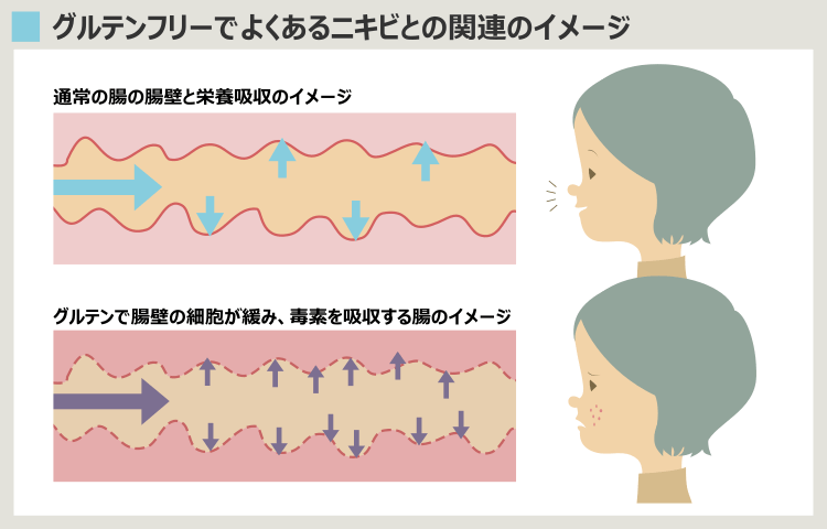 グルテンが腸内環境を悪化させニキビの原因になると言われる理由