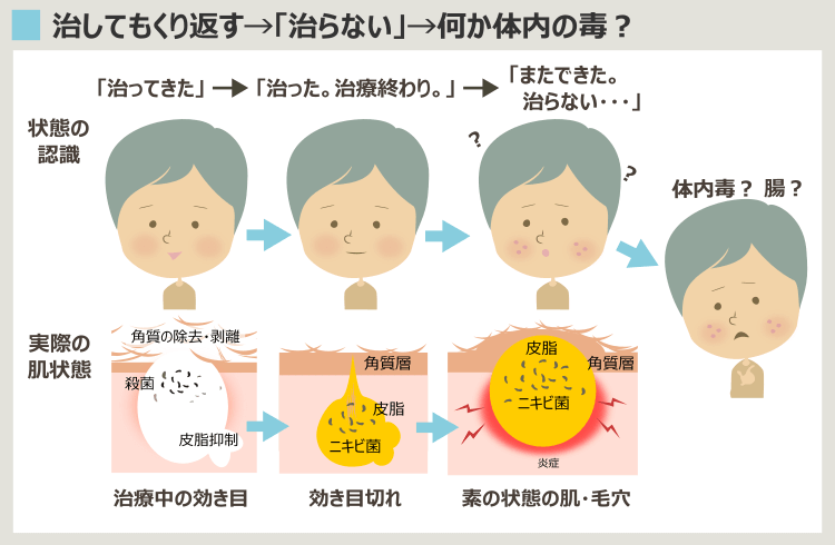 グルテンフリーでニキビが治ると思われるようになる経緯