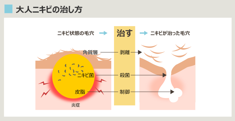 大人ニキビの治療法、大人ニキビケア