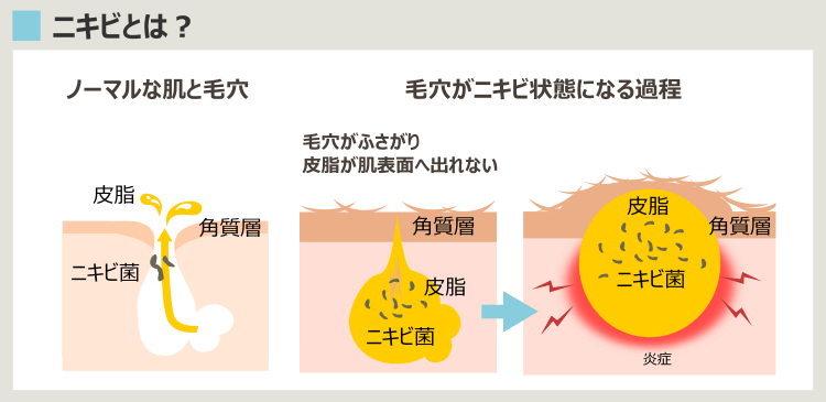 ニキビの原因とは?