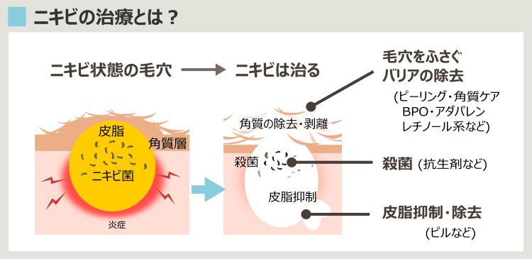 ニキビ治療・治療薬の一覧とその効果