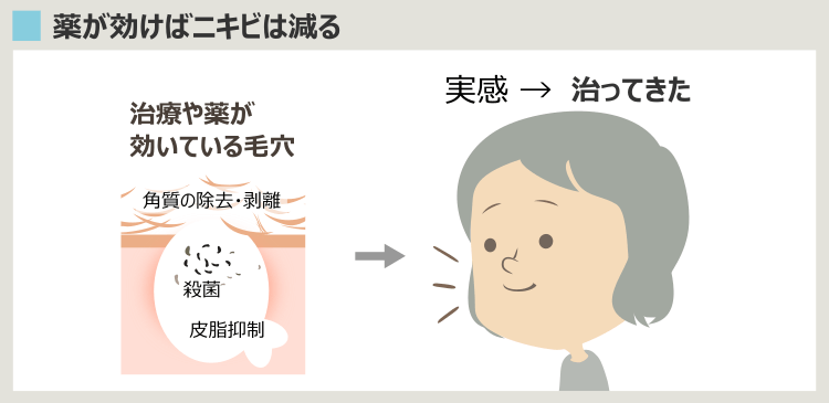 「ニキビが治る」とはどういうことか?