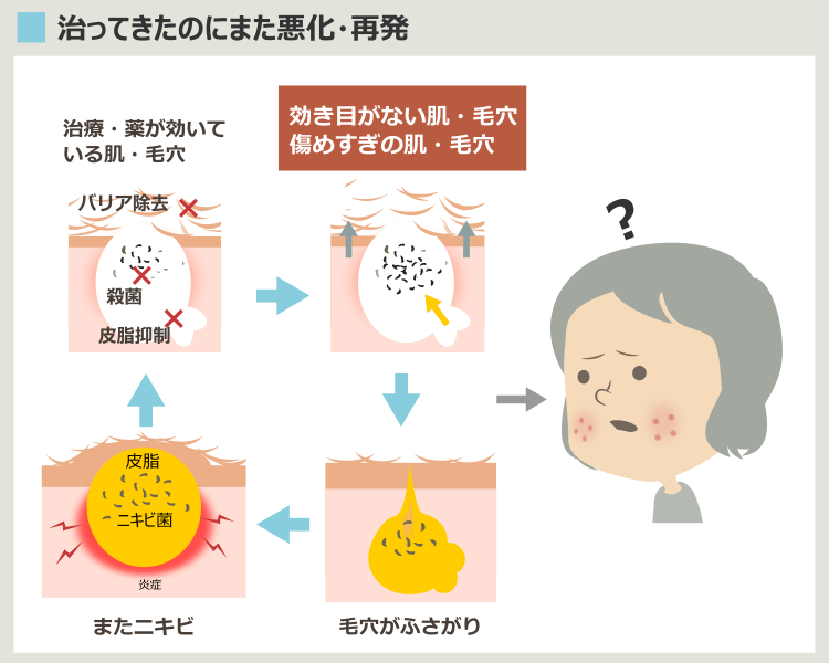 治ってきてもくり返すニキビ