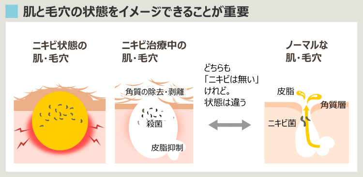ニキビが無くなっても、解決はしない理由
