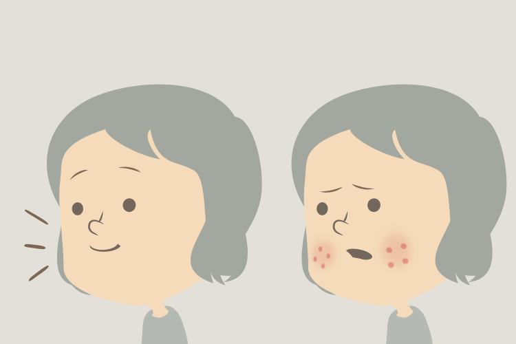 治ってきたと思っていたニキビがまた再発