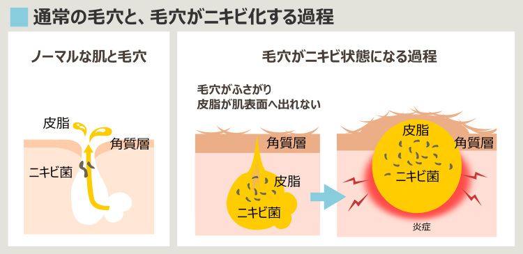 薬に頼らずニキビを治したい-ニキビができる過程