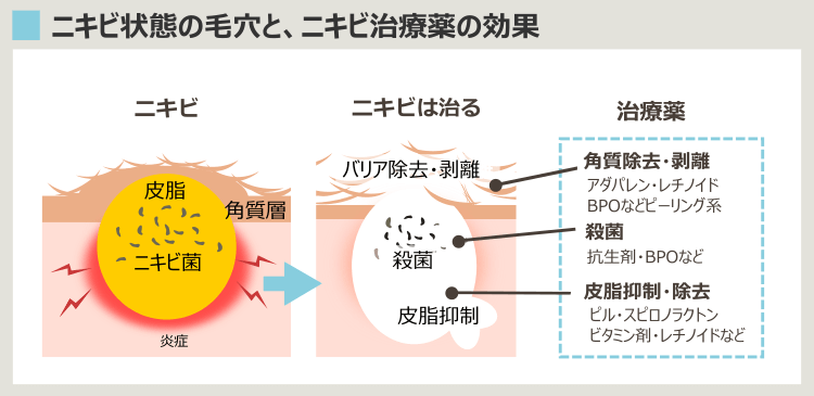 薬に頼らずニキビを治したい-ニキビ治療の効果